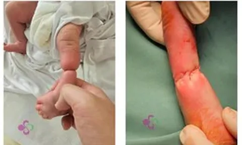 Hy hữu: Trẻ sơ sinh bị vòng xơ thắt nghẹt cẳng chân từ trong bụng mẹ