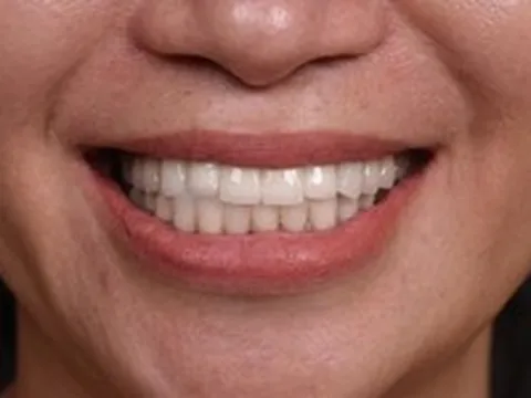 Những trường hợp nào không nên làm răng sứ?