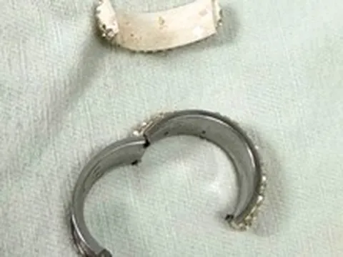 Cấp cứu nam thanh niên bị thắt nghẹt dương vật do đeo 'cock ring'