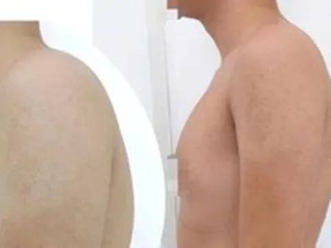 Cổ rụt, lưng gù vì ngồi vẹo vọ, bò dài trên bàn: Chữa thế nào?