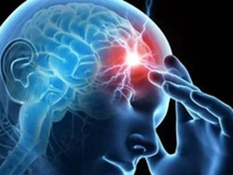 Chóng mặt, buồn nôn: Dấu hiệu đột quỵ tiểu não dễ nhầm với rối loạn tiền đình