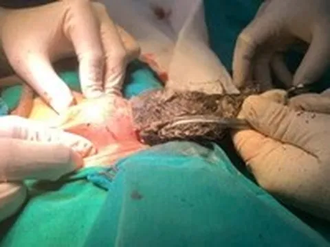 Bé 46 tháng tuổi nuốt búi tóc dài 20cm trong dạ dày