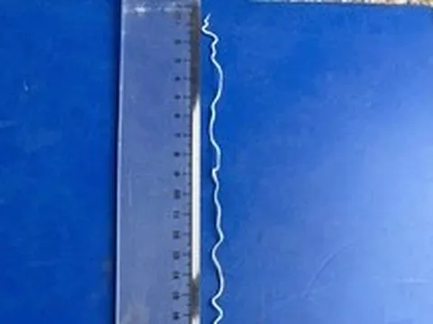 Tự nặn mụn trên cánh tay, phát hiện con giun rồng dài 20cm dưới da